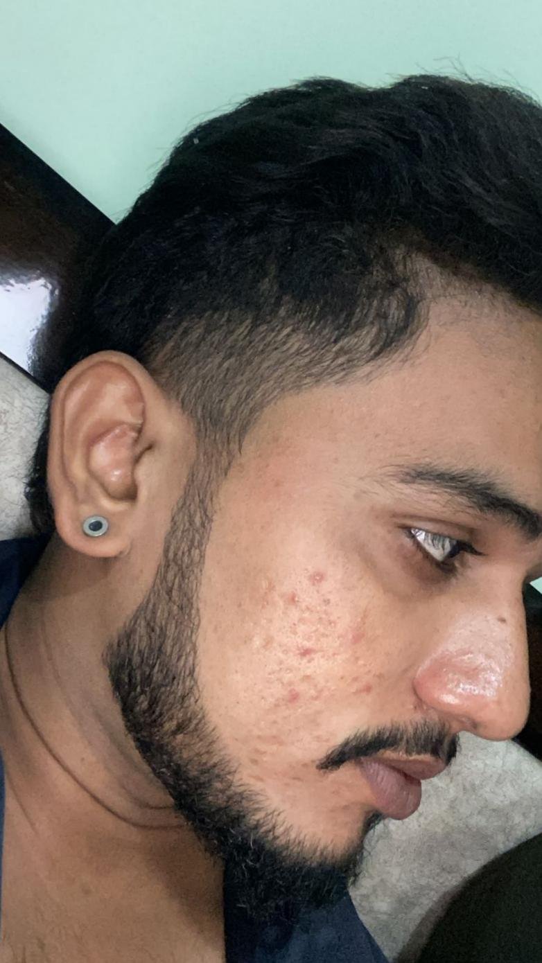 Customer skin after using ADNC night cream